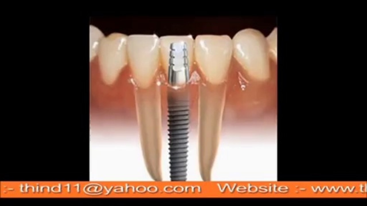 Dental Implants