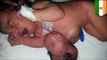 Parasitic twins: Indian baby girl born with an extra head attached to her abdomen