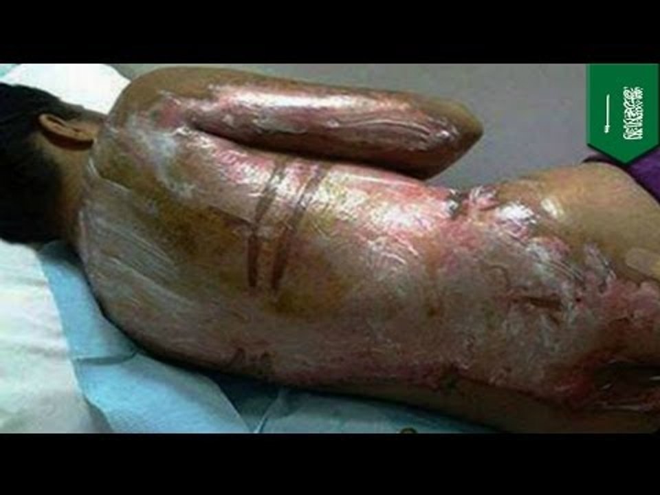 Gruesome attack photo: Filipino maid burned after Saudi boss drenches her with boiling water