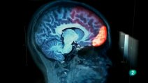 Cerebro Asperger: Lobulo frontal