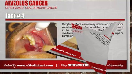 Information about Alveolus Cancer