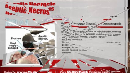 Information about Aseptic Necrosis