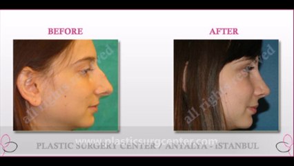 RHINOPLASTY (Nose Job) Surgery in TURKEY/ANTALYA