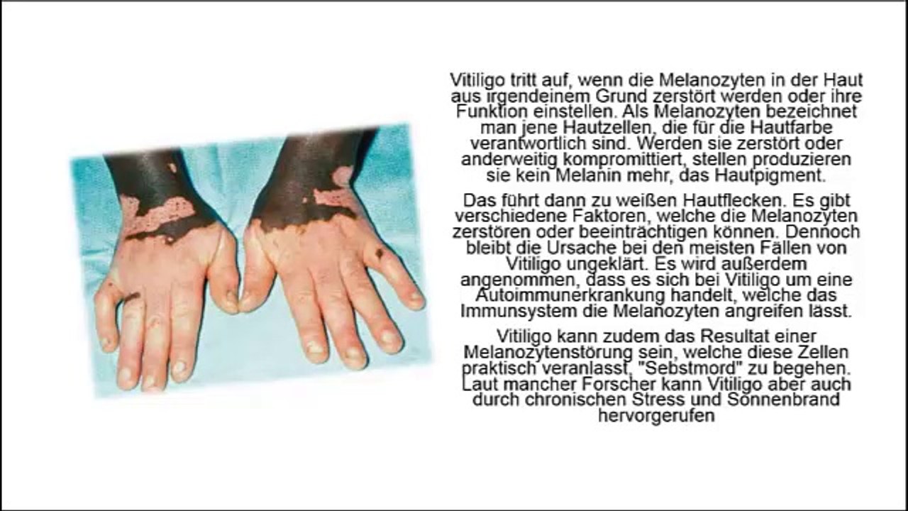 Hautkrankheit Vitiligo, Schüssler Salze Vitiligo, Vitiligo Bund, Vitiligo Homöopathie