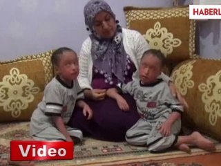 Balık Pulu Hastalığına Yakalanan İkizler Yardım Bekliyor