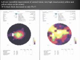 3rd Medical Test Results of Retinitis Pigmentosa Patients Treatment - Firatli Clinic