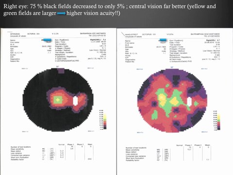 4th Medical Test Results of Retinitis Pigmentosa Patients Treatment - Firatli Clinic