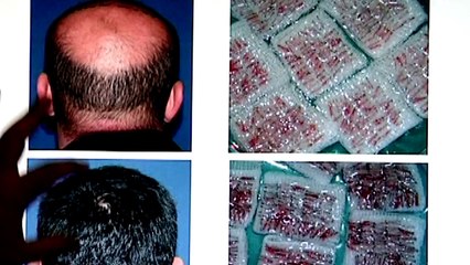 DR ONUR GURBUZ SAÇ EKİMİ