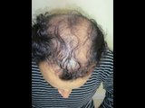 Cheap or Affordable Fue hair transplant in pakistan