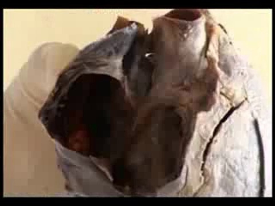 Right Atrium