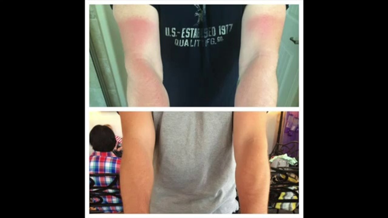 Argan Oil For Skin Video Demonstration – Heal Sunburns