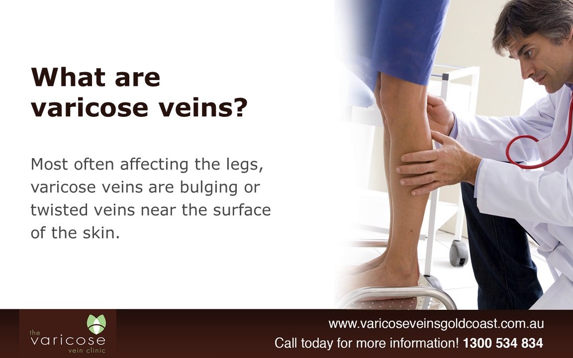 How To Prevent Varicose Veins in Winter