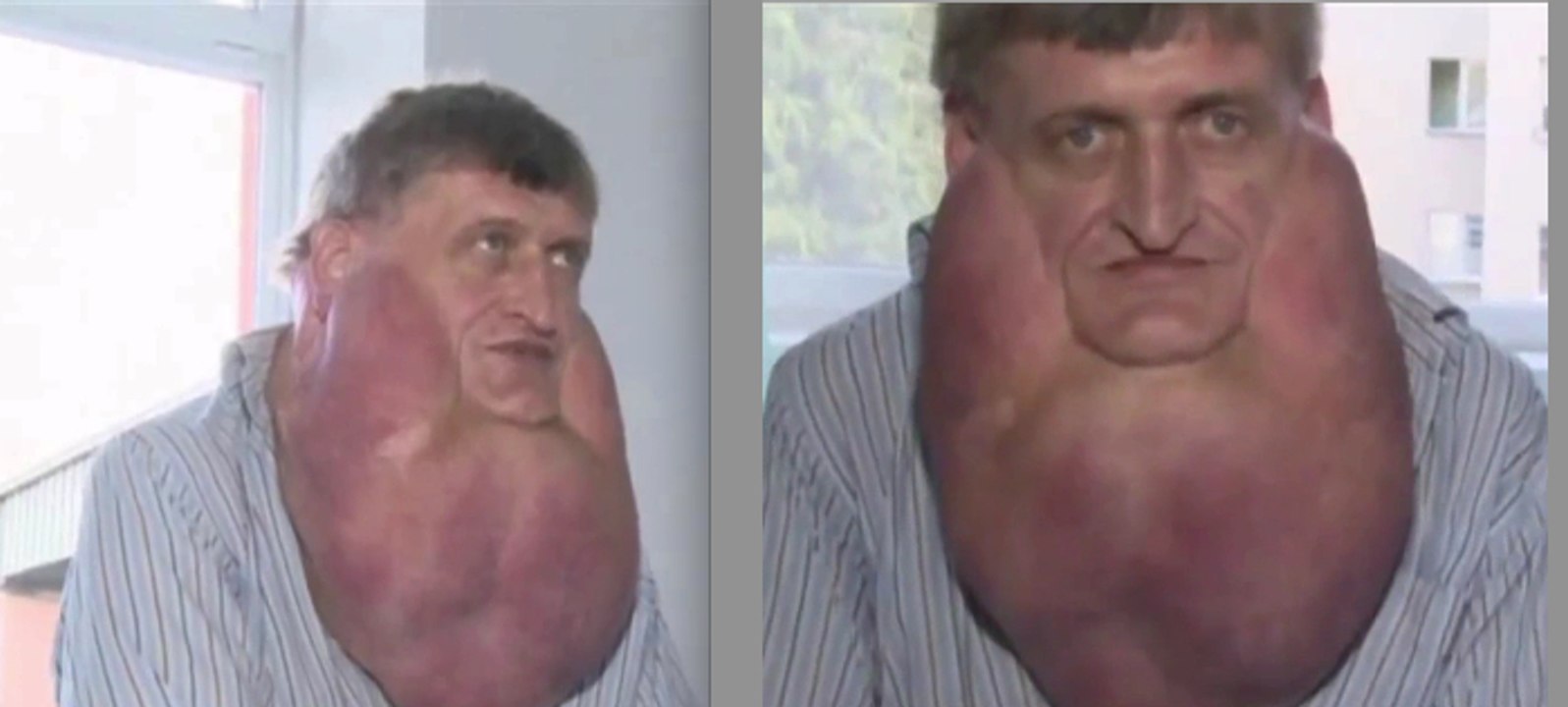 Il se fait retirer une méga-tumeur de 6 kilos !