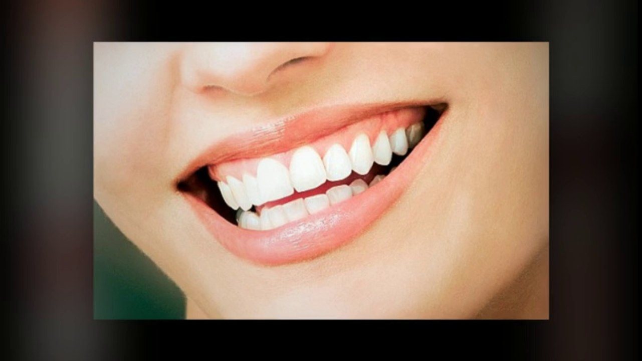 Veneers Westminster May2014