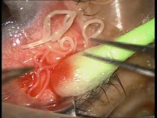 20 Cm Long Worm in Human Eye