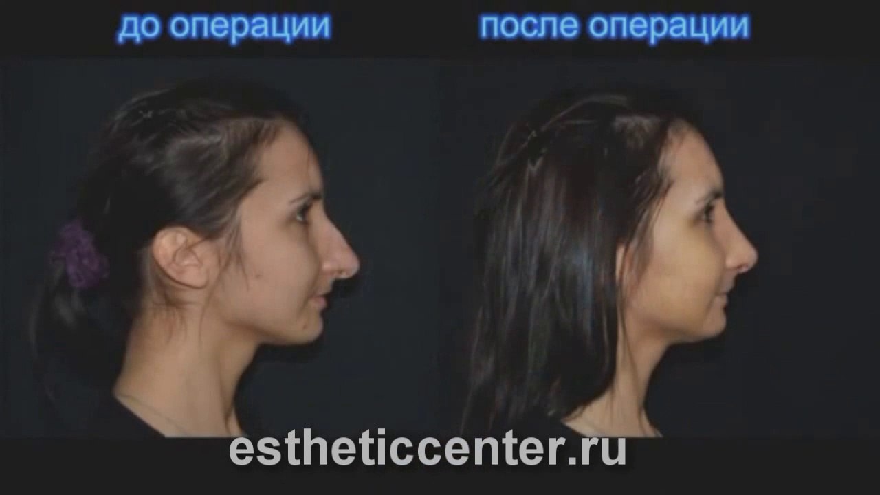 Ринопластика отзывы http://estheticcenter.ru