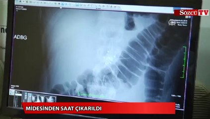 Midesinden saat çıkarıldı