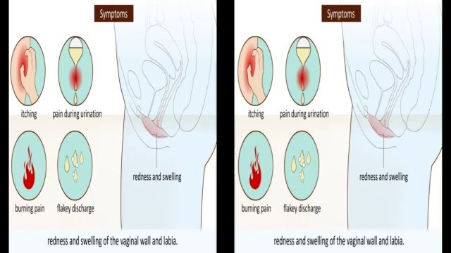 Vad är svamp och hur behandlas det?