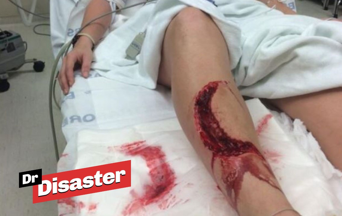 Un requin arrache la jambe d'une fille en Floride  / Dr disaster