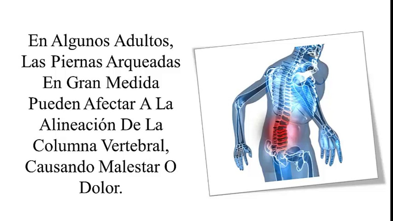 Ejercicios Para Corregir Piernas Arqueadas, Ejercicios Para Piernas Torcidas, Enderezar Piernas