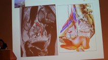 Female Pelvic Masses Ultrasound And MRI - Anne-Elodie Millischer-Bellaïche - Monday 27th January - Part 2