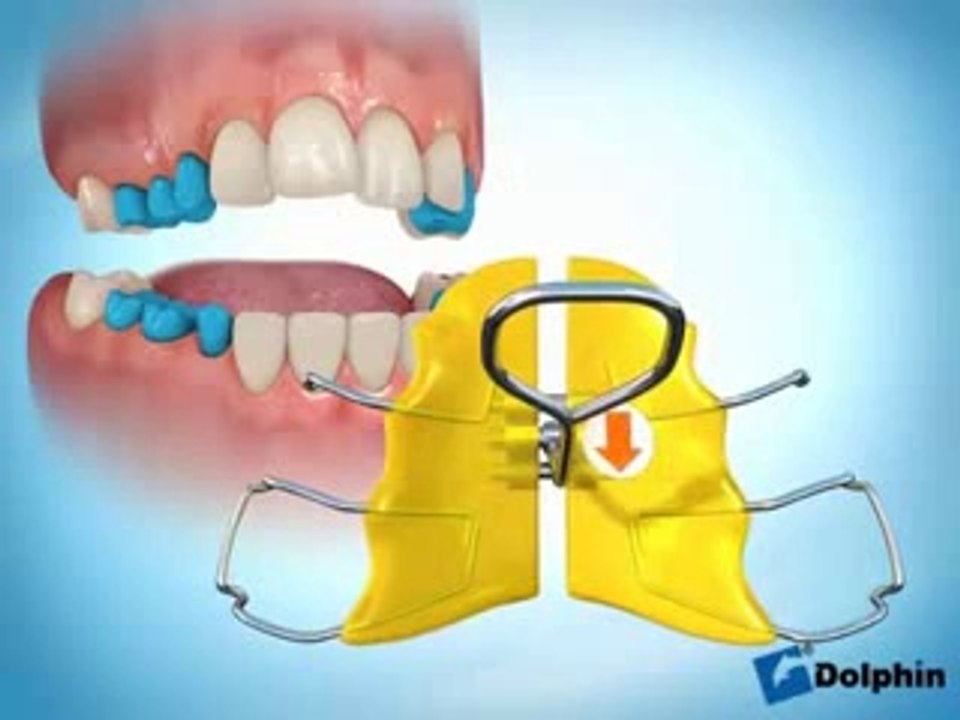 Hareketli Aparey İle Üst Çene Genişletme