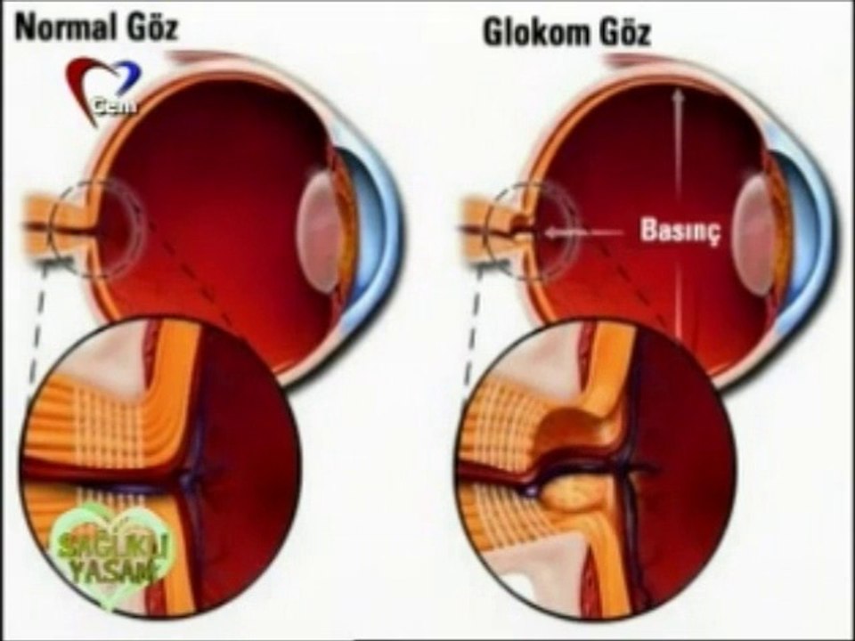 göz tansiyonu / demet kaytan ile sağlıklı yaşam