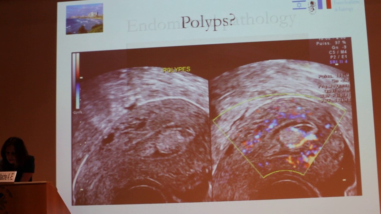 Imaging Female Infertility Ultrasound And MRI - Anne-Elodie Millischer-Bellaïche - Monday 27th January - Part 1