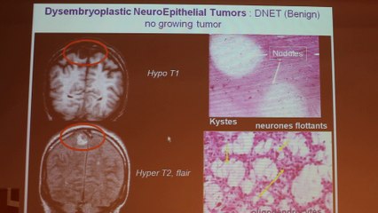 Morphological Imaging In Epilepsies - Nathalie Boddaert - Tuesday 28th January - Part 1