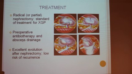 XanthoGranulomatis Pyelonephritis - Alexandra Benarrous - Tuesday 28th January 2014