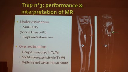 Bone Tumors In Children What Should We Know - Saliha Djebbar - Tuesday 28th January 2014 - Part 2