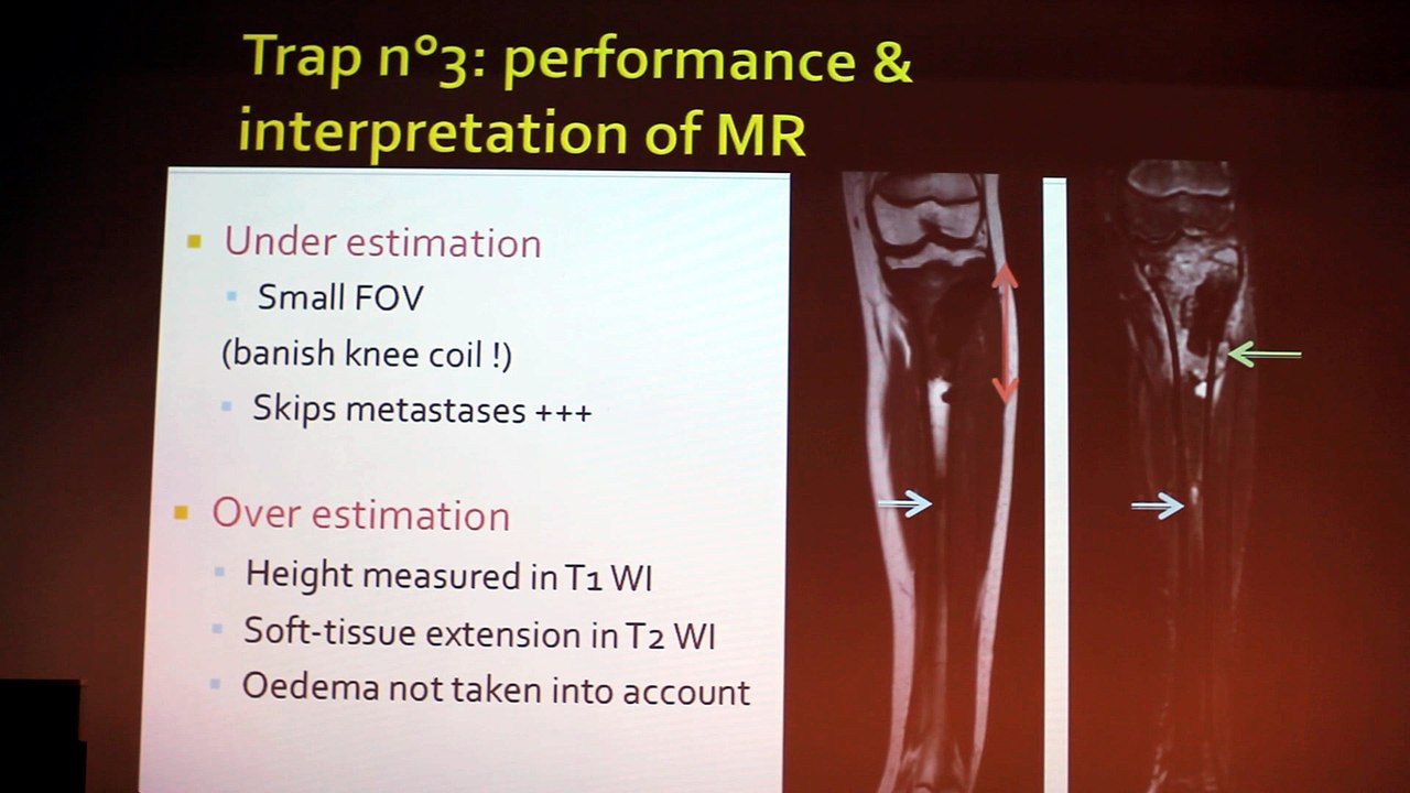 Bone Tumors In Children What Should We Know - Saliha Djebbar - Tuesday 28th January 2014 - Part 2