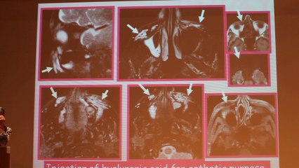 Cervical And Facial Bumps MRI Approach - Françoise Héran - Wednesday 29th January - Part 1