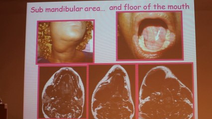 Cervical And Facial Bumps MRI Approach - Françoise Héran - Wednesday 29th January - Part 2