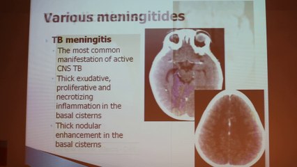 Infectious Diseases Of The CNS - Ayelet Eran - Wednesday 29th January - Part 2