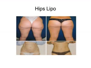 Liposuction Plastic Surgeon