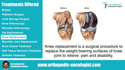 Orthopedic Surgeon in Bangalore | Arthritis treatment in Bangalore