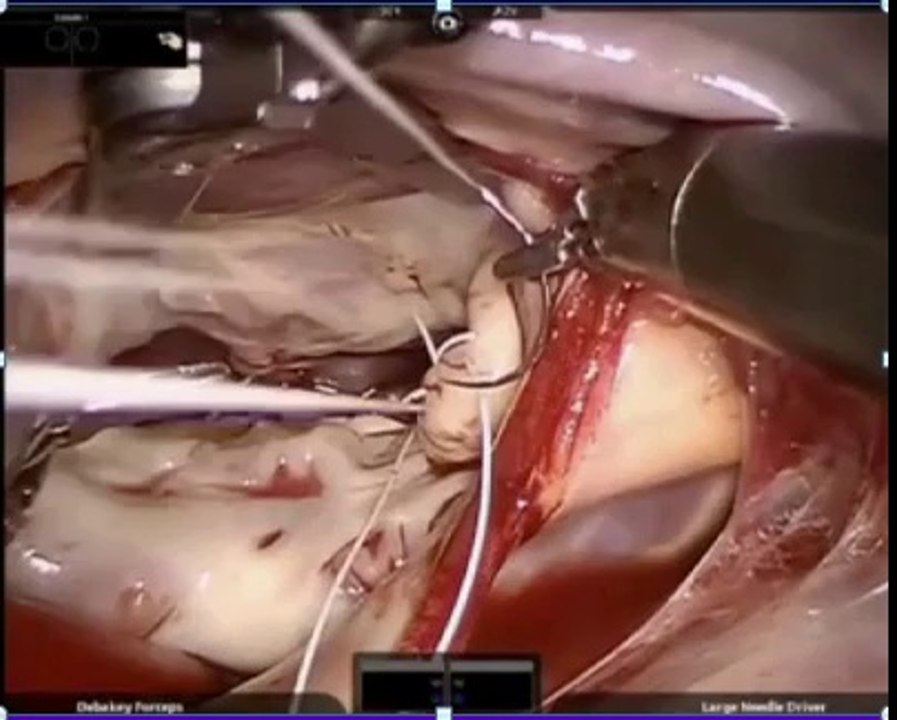 Learn  more about mitral valve repair recovery