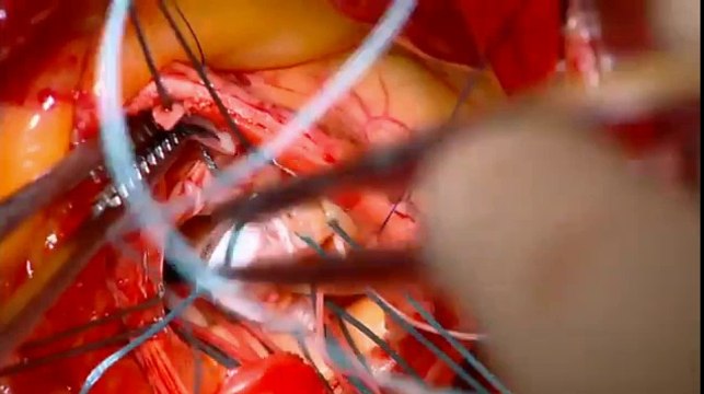 Mini AVR is best method for valve replacement aortic valve replacement