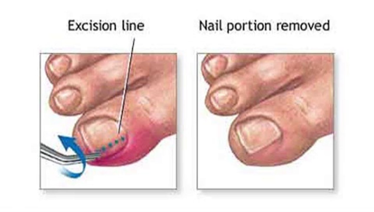 Rome, GA -  Ingrown Toenails - Podiatrist Brian Middleton, DPM
