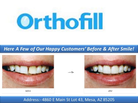 Orthofill Teeth Gap Bands