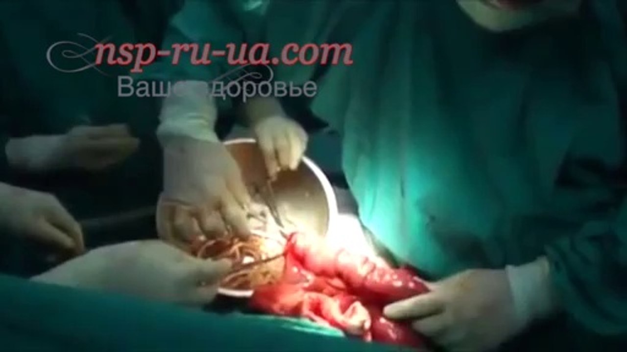 Операция удаления гельминтов из кишечника человека
