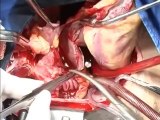 Cardiac Transplant