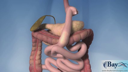 Download Video: What is Roux-en-Y Gastric Bypass? by Bay Bariatric Surgery