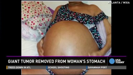 Woman mistakes 27-pound tumor for 'weight gain'
