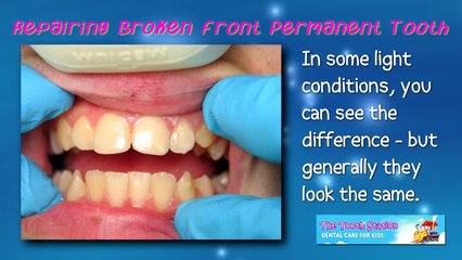 Anterior Fracture Repair - Pediatric Dentist - The Tooth Station