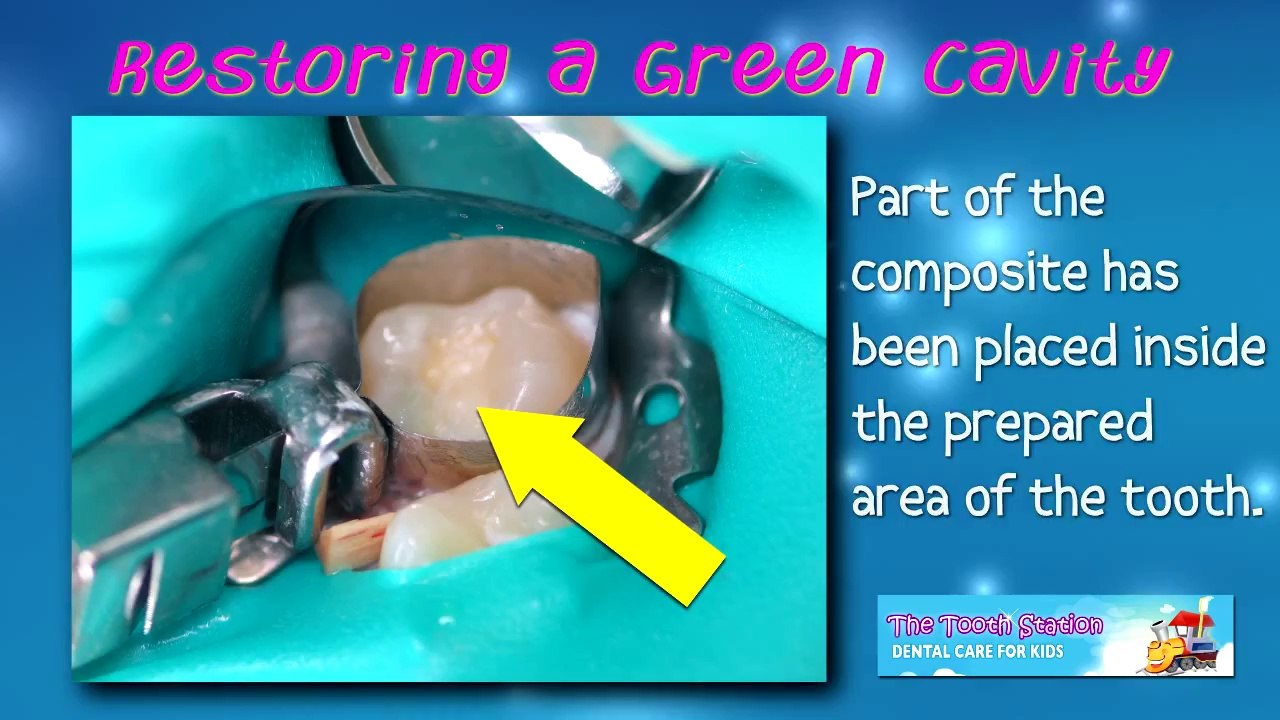Green Cavity Treatment - Pediatric Dentist - The Tooth Station
