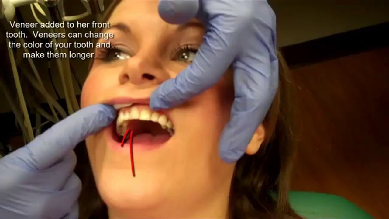 Dental Veneers in Louisville Kentucky - Get a Hollywood Smile