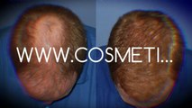 hair restoration - hair spa - hair thinning - Plastic Surgery Chennai - Dr. Ari Chennai - Dr. Ari Arumugam