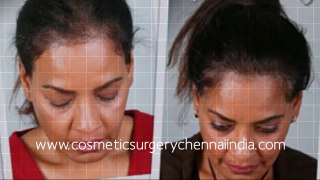 hair growth shampoo - hair implants - hair loss - Hari Loss Treatment Chennai - Dr. Ari Chennai - Dr. Ari Arumugam